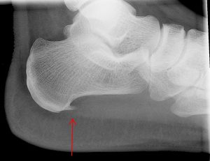 xray of a bone having plantar Fasciitis